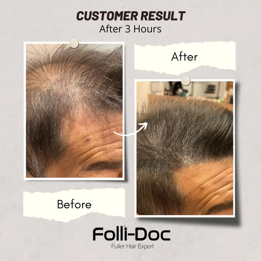 Folli-Doc before after