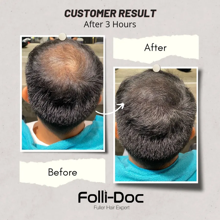 Folli-Doc before after
