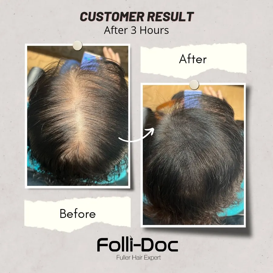 Folli-Doc before after