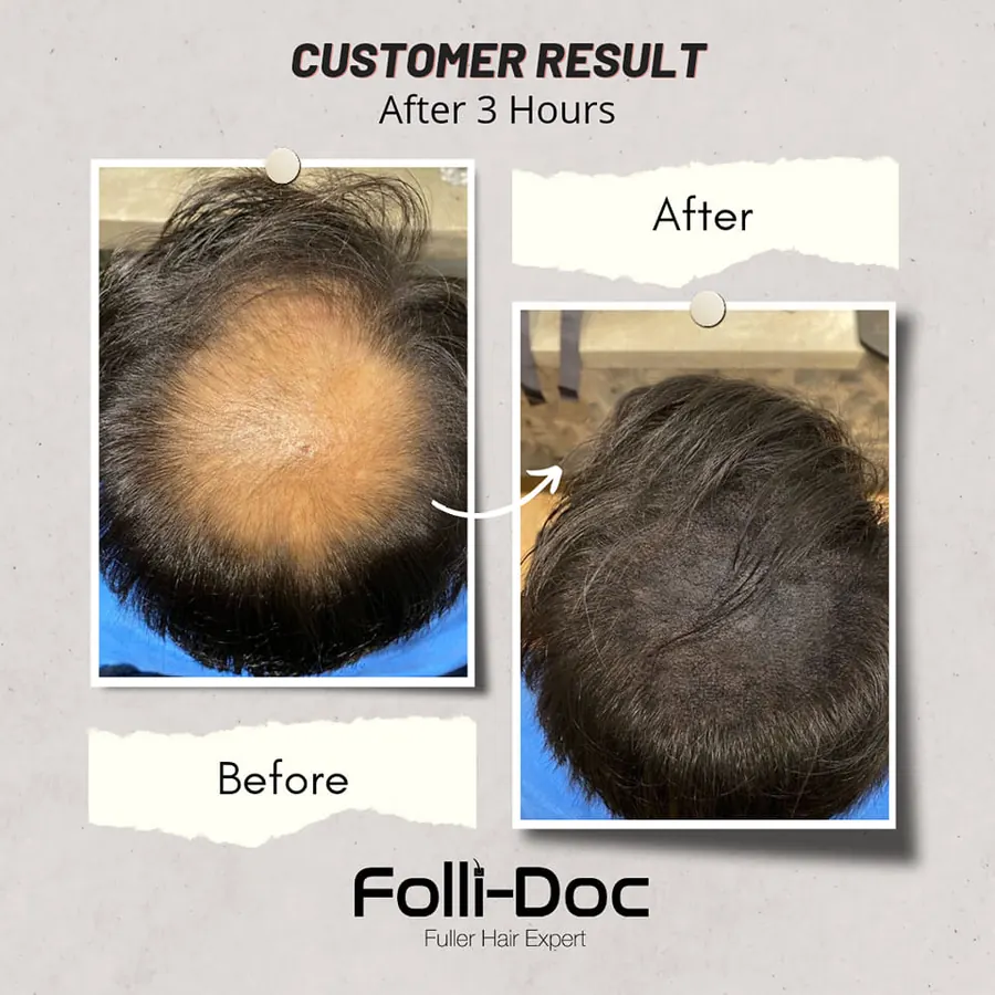 Folli-Doc before after