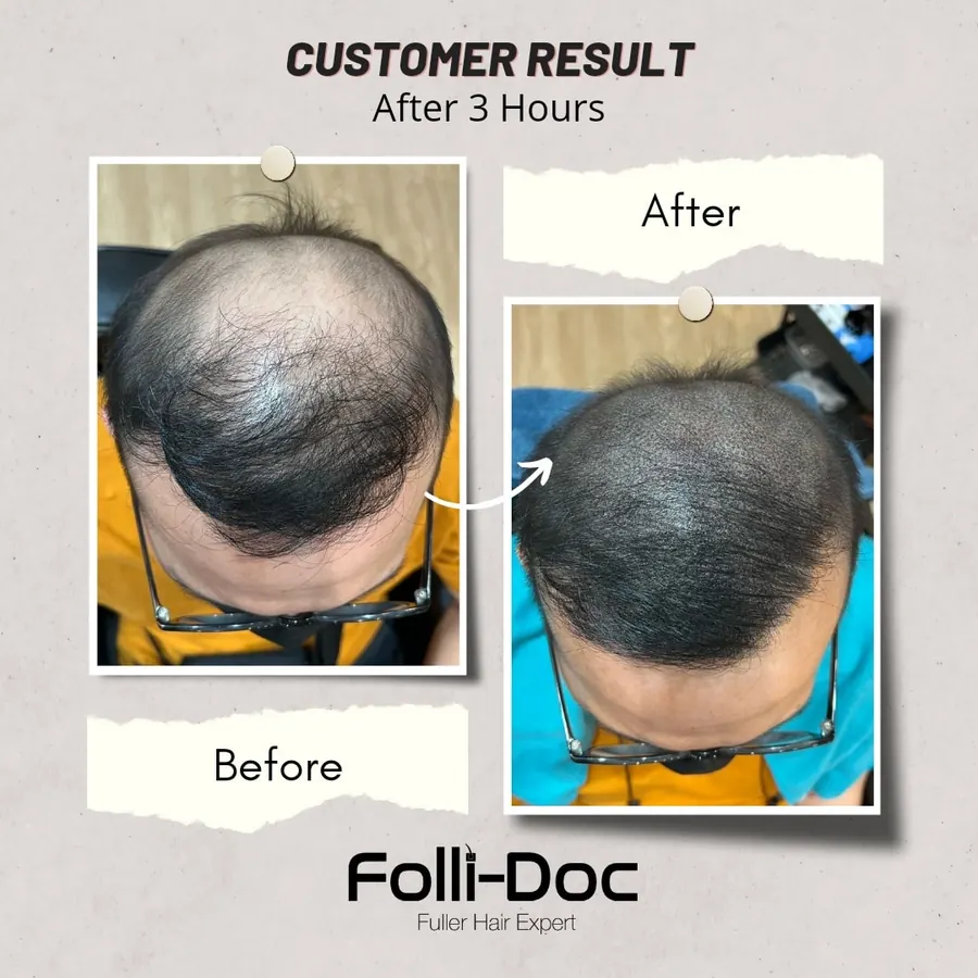Folli-Doc before after