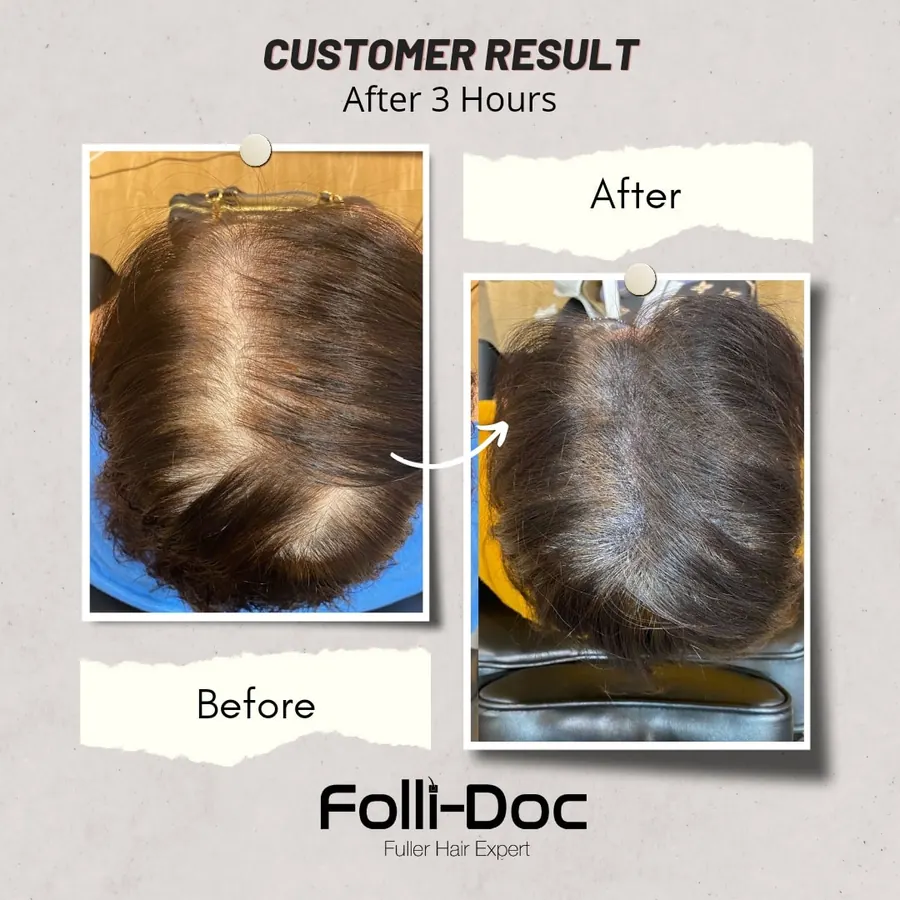 Folli-Doc before after